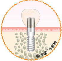 implant-2