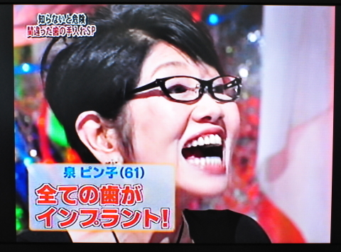 女優の泉ピン子さんの歯はすべてインプラントだそうです