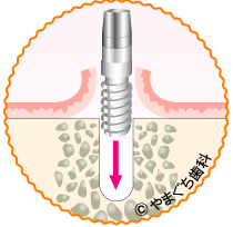 implant-1